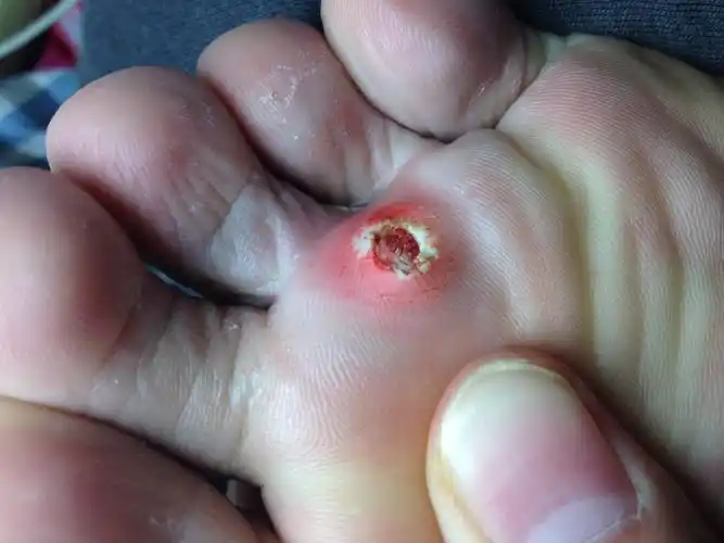 我现在脚上的鸡眼到这种程度下一步我应该怎么办