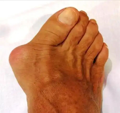 拇外翻应该怎么治疗好