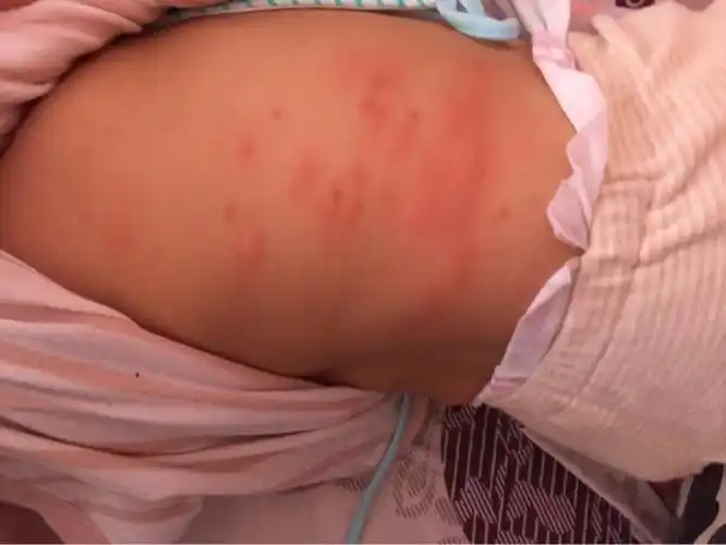 宝宝身上长了好多红疙瘩,红一片,只有腰这边有