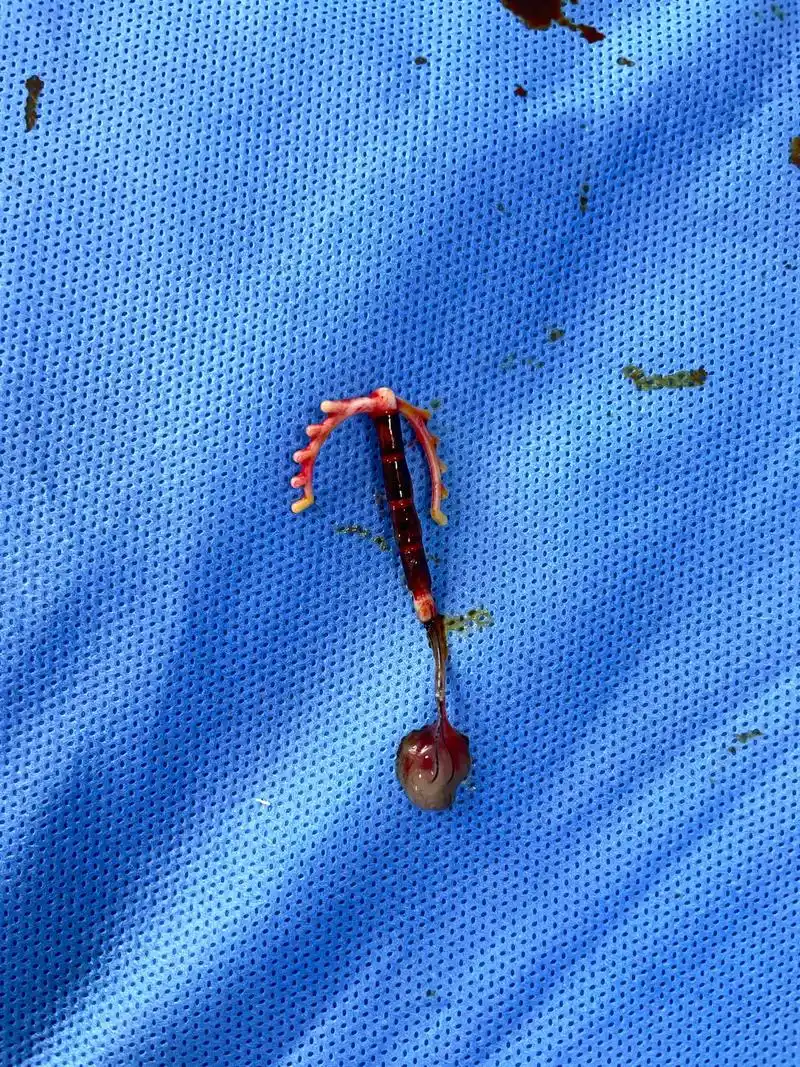 今天终于鼓起勇气把呆在我身体里8年多的环取出来了,感受着医生 - 抖