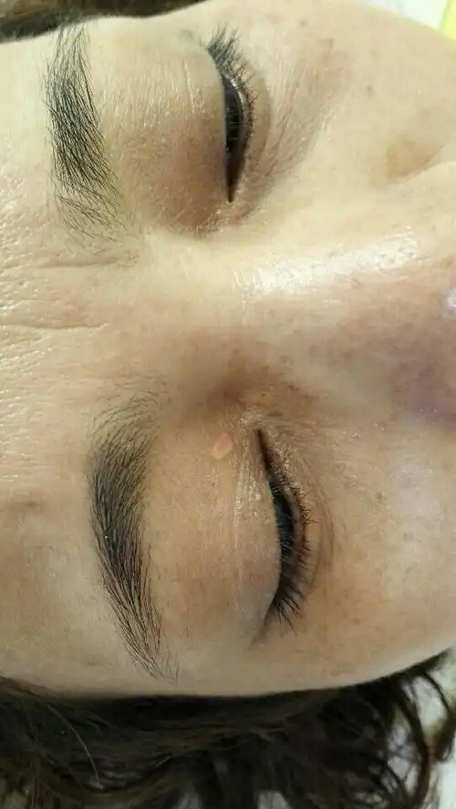 眼睑上长淡黄色肿物,有危险吗?