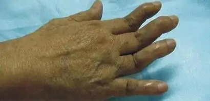 类风湿该喝些什么药