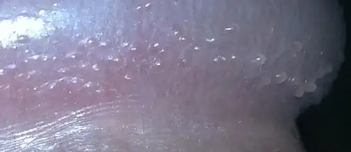 展开全部 珍珠疹是男性阴茎冠状沟处的一种常见的皮损,主要是生理性