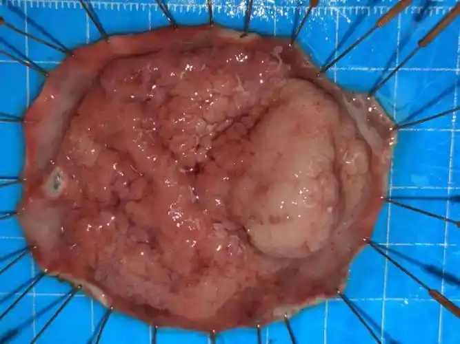 90岁老人患结直肠肿瘤微创手术为他摘除隐患