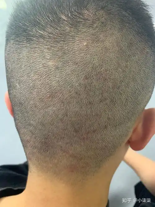 头皮上有很多红色连片的疙瘩怎么办