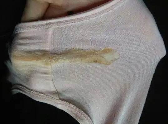 白带呈豆腐渣状图片6