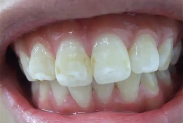 以前是一点小白斑,后来越来越大.很多年了.牙齿其他地方颜色有点深.