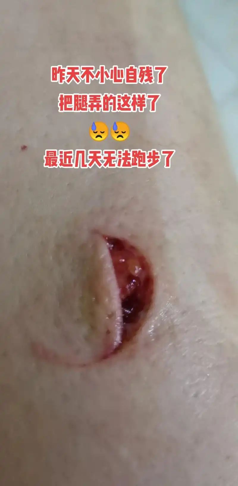 自残了,发现痛全转移到了伤口上了[捂脸]由于我的疏忽我的腿受 - 抖音