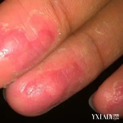 【图】手指头脱皮是怎么回事?4大方法教你轻松摆脱手脱皮的困扰