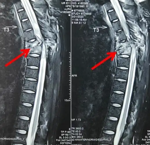一位39岁的安先生不慎被重物砸伤,导致全身多发伤,胸椎骨折导致他当场