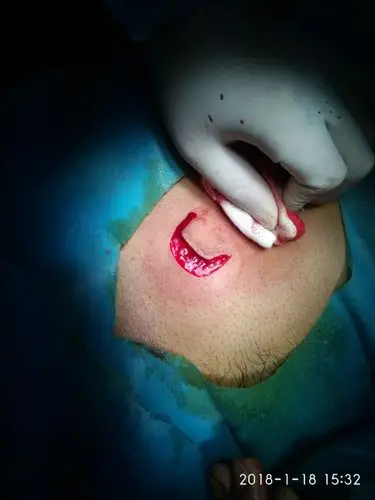 手指外伤皮肤缺损应用腹部带蒂皮瓣移植术治疗详解