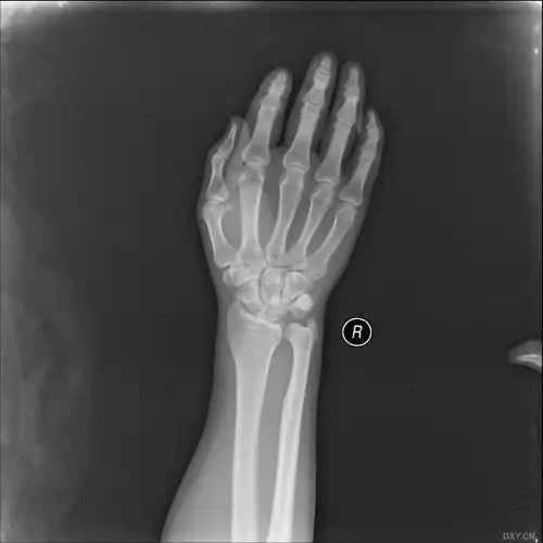 【读片】腕关节脱位 [病例帖]