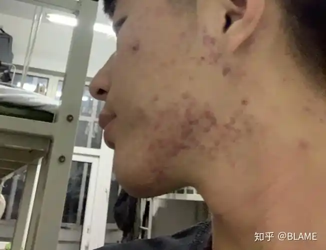 腮边痘痘 - 知乎