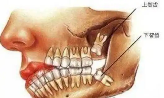 不需要拔的智齿图片这4种情况下的智齿其实并不需要拔