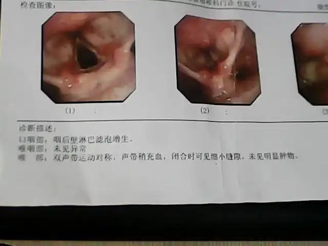 求助阿 声带闭合不全 充血 说话难受 胸闷