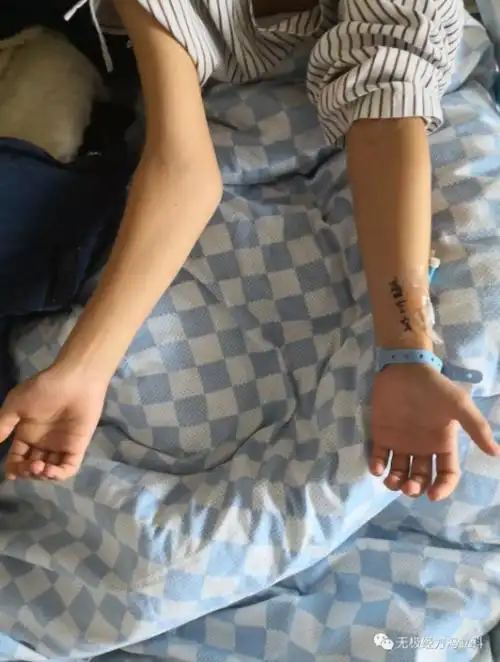 骨折,没有正确复位,导致骨折没有正常愈合,从而导致发育异常,肘外翻了