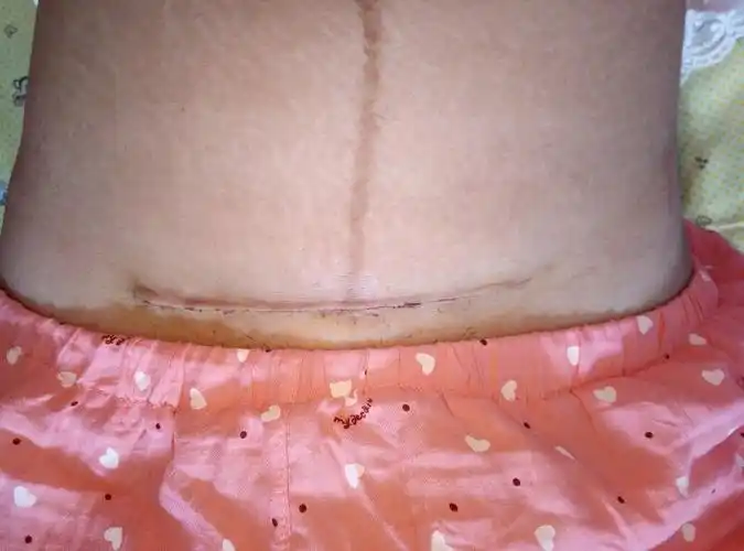 剖宫产术后刀口恢复对比(有图)求投票