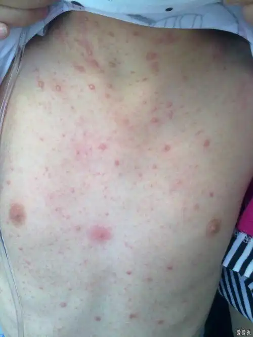 一例女性全身泛发性皮疹查因?