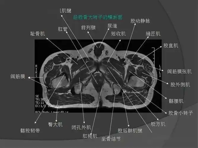 骨盆肌肉mri断层解剖