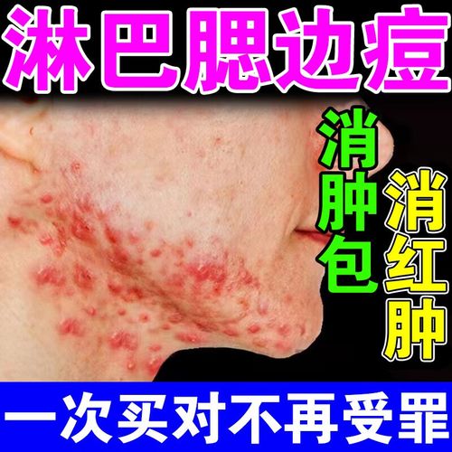 下巴红肿硬痘痘 淋巴痘腮边痘下巴反复长痘痤暗疮疮