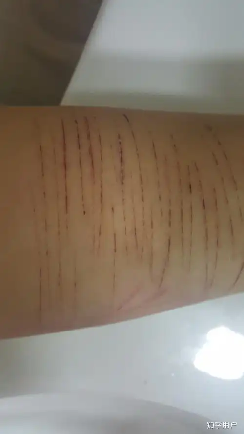 忧郁症自残是什么感觉