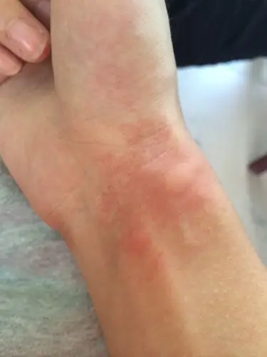 皮肤过敏是一种过敏原刺激皮肤造成的变态反应,是过敏原直接或间接