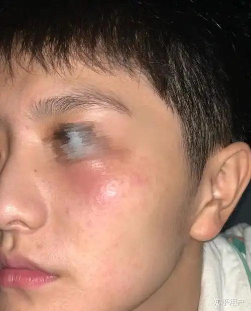 油性皮肤的男生怎样保养皮肤