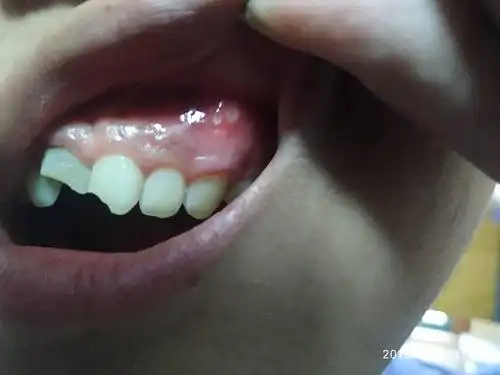 牙龈上长了个小脓包一样的东西,很痛,这是则么回事