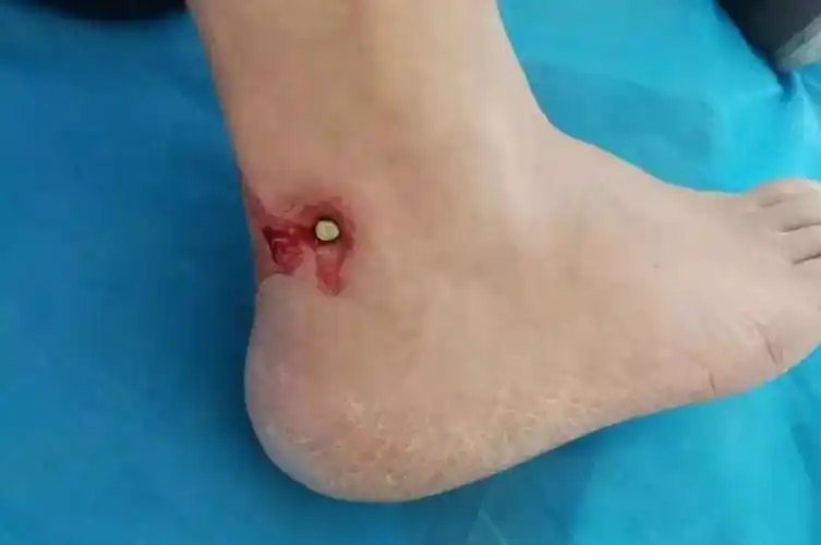 痛射钉枪走火五厘米钢钉打进脚后跟