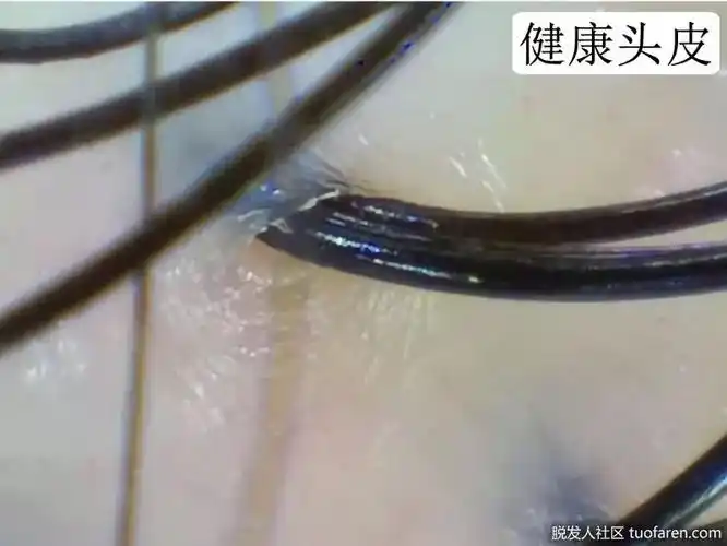 正常头皮毛囊图