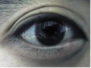 【引用】急性闭角型青光眼