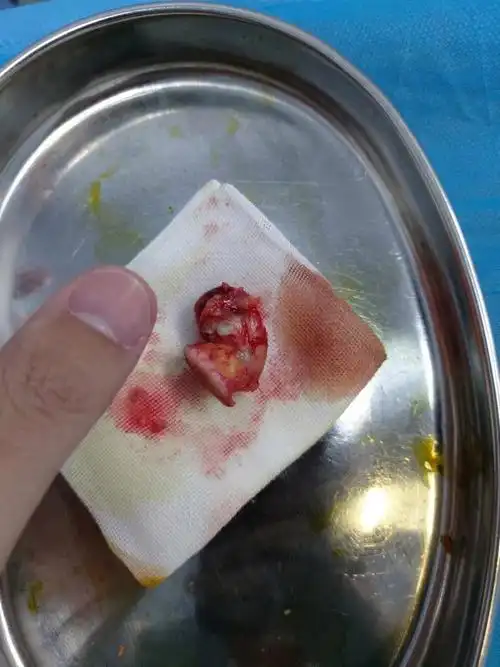 粉瘤切除手术 - 知乎