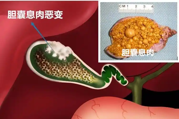 科普|胆石症/胆囊息肉在什么情况下需要做手术_胆囊息肉_胆囊息肉治疗