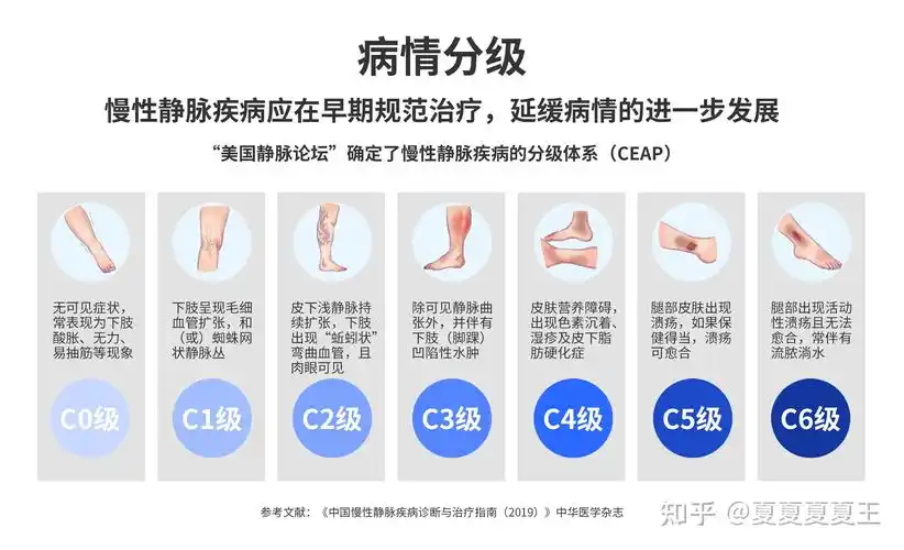 得了静脉曲张会选择穿静脉曲张袜治疗吗