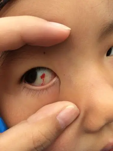 宝宝眼白有血块 怎麼办