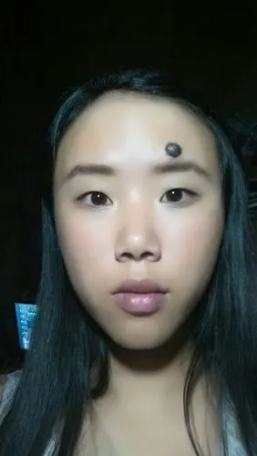 我是护理专业,脸上有一个大痣,要取掉吗?