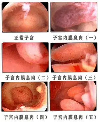 根治宫颈息肉首先遏制源头