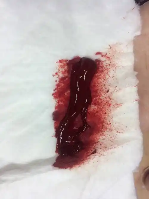 根据血液的情况可以判断病情,泻出的血液,一但离开人体,随着温度的