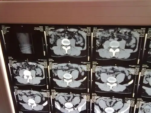 第五腰椎椎板不连怎么办?