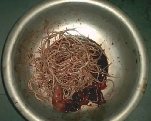 儿童肚子蛔虫图片 (19)_有来医生