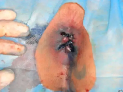 今天做的两例痔疮手术谢谢大家拍砖