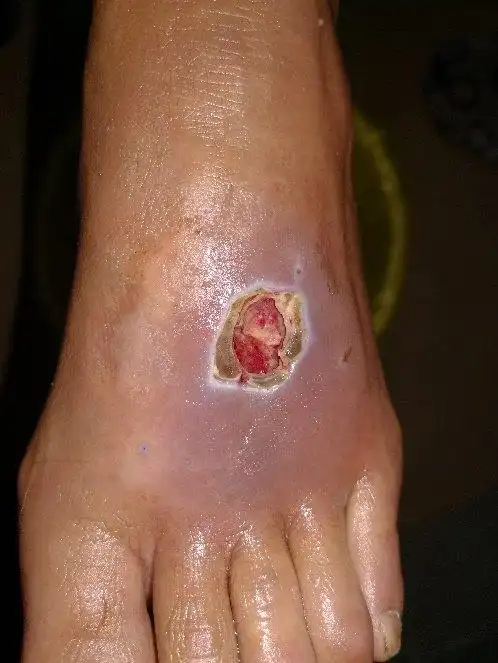 年关将至,处理水产生禽一点要注意,谨防类丹毒_类丹毒_介绍_症状表现