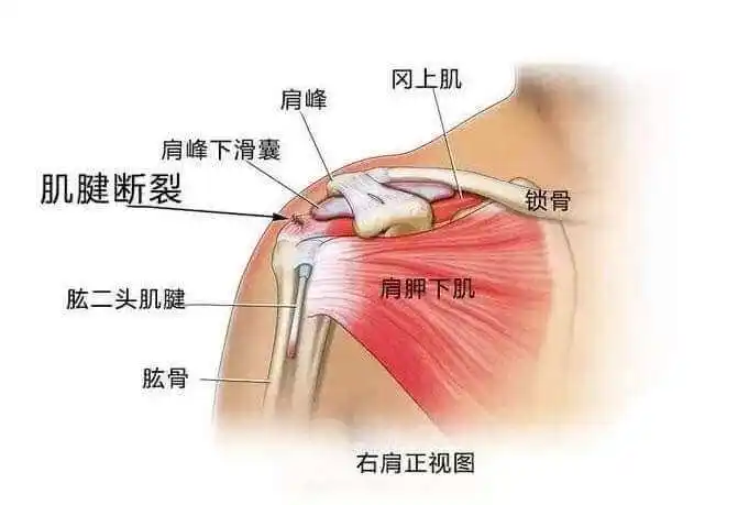 肩周炎的定义及病因(肩周炎怎么诊断治疗)_大全-幸福起航