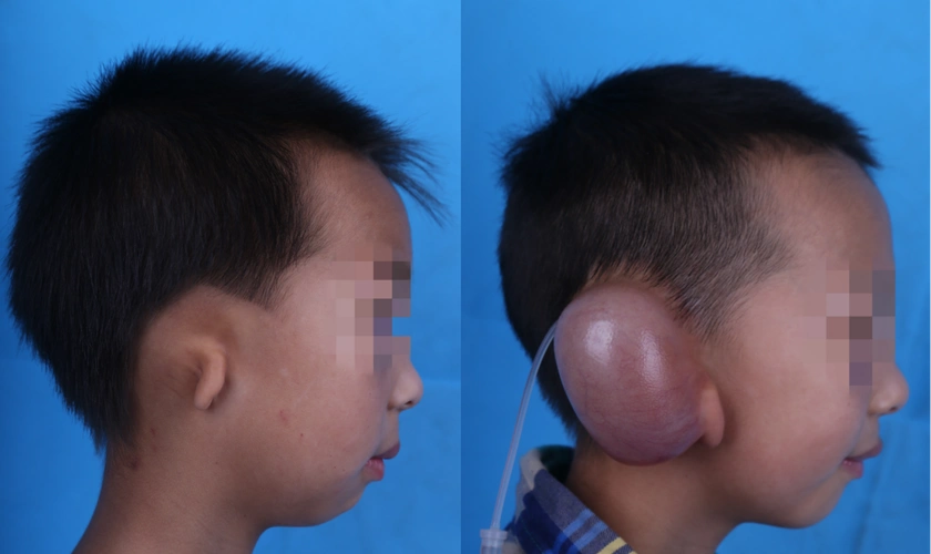 皮肤扩张术多少钱 皮肤扩张术