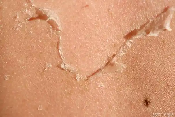 而皮肤表面由角质层,颗粒层,透明层,基底层等组成,其中角质层是最外面