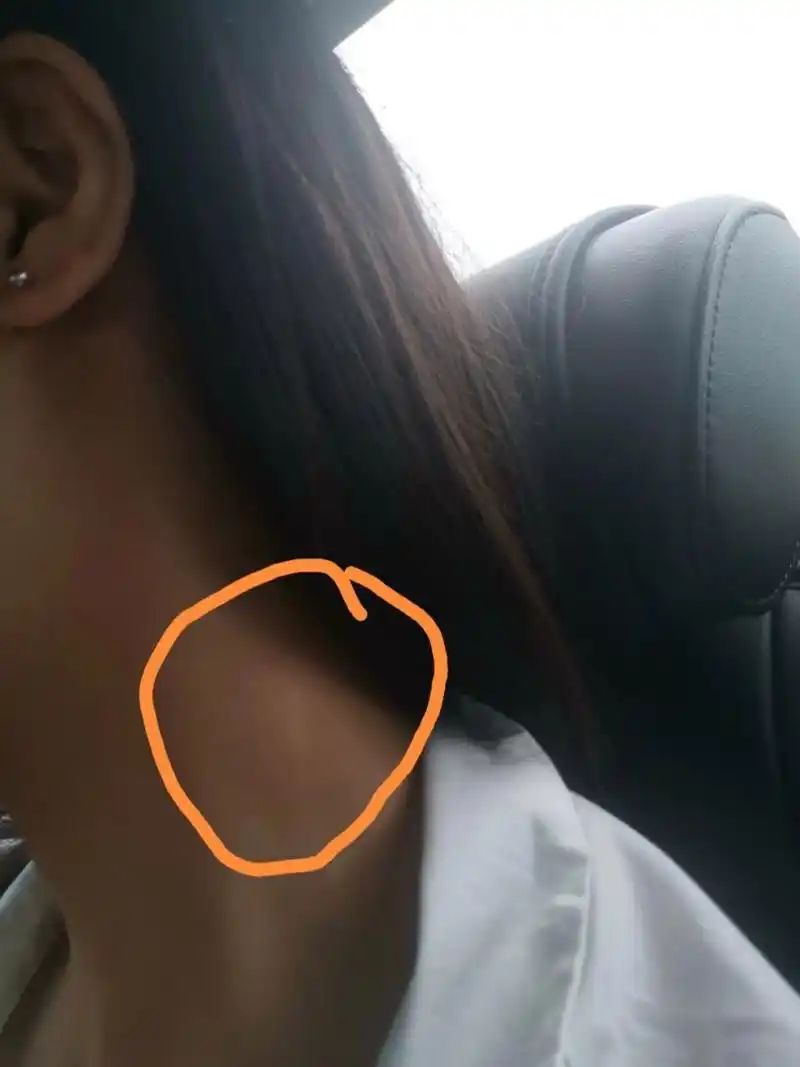 求助友友们帮我看看这个包 昨天脖子左侧突然长了一个小包,感觉里面是