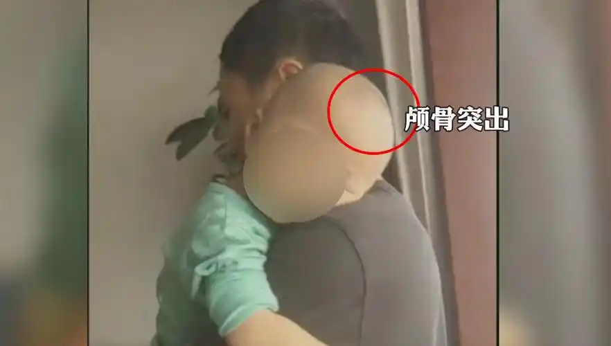 湖南郴州永兴县有多位爸妈发现自家孩子出现了湿疹,频繁拍头,颅骨突出