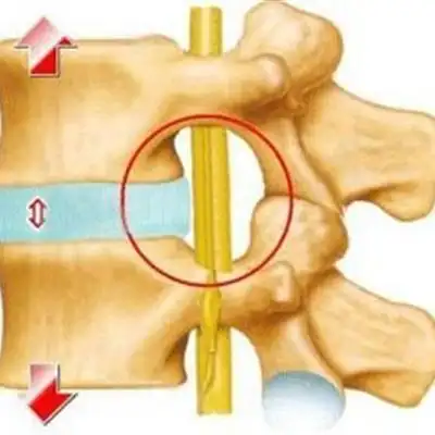椎管狭窄手术后多久可以下床