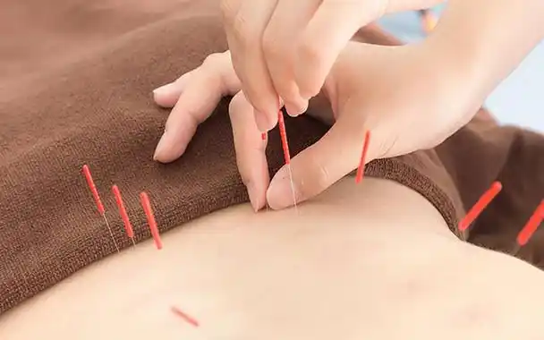 女人针灸理疗好不好女性针灸之后能不能同房