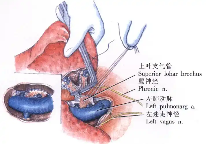 左肺上叶切除术详解-手术图解